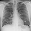 Das Röntgenbild des Brustkorbs wird aussagekräftiger (Foto: pixabay.com, oracast)
